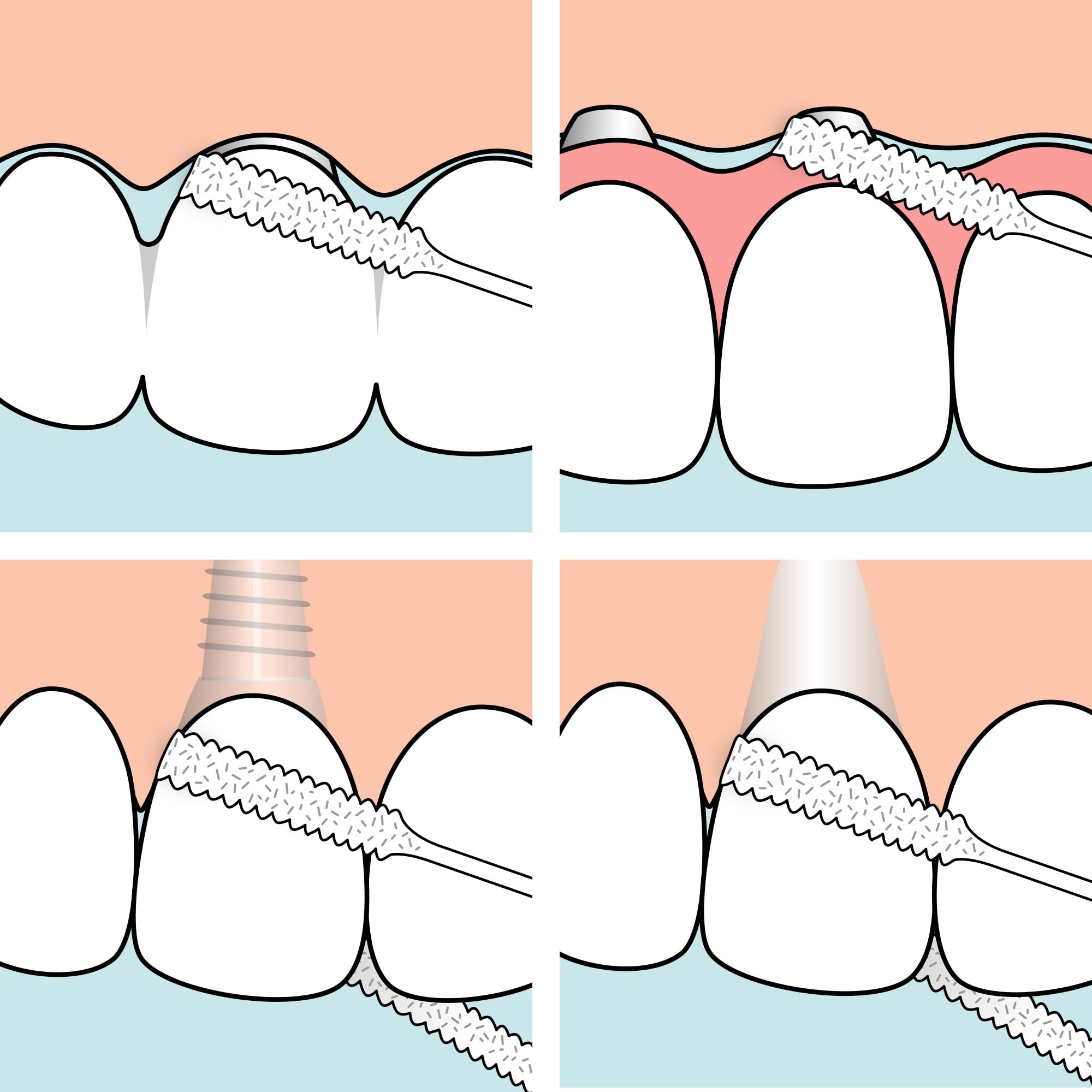 tepe-bridge-implant-floss-zahnseide-30-st-ck image 5